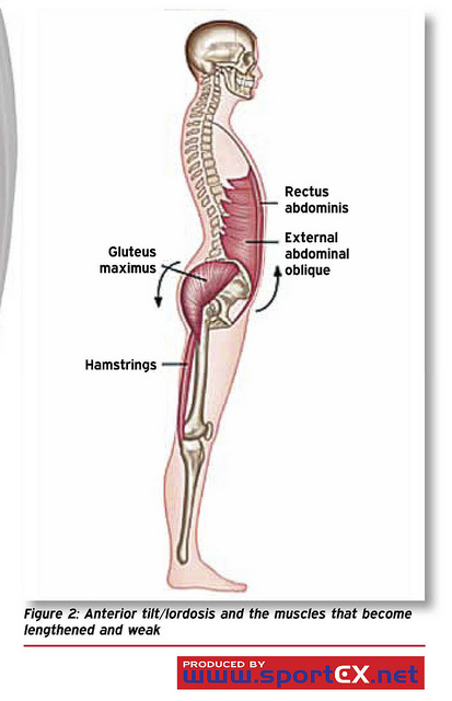 anterior pelvic tilt